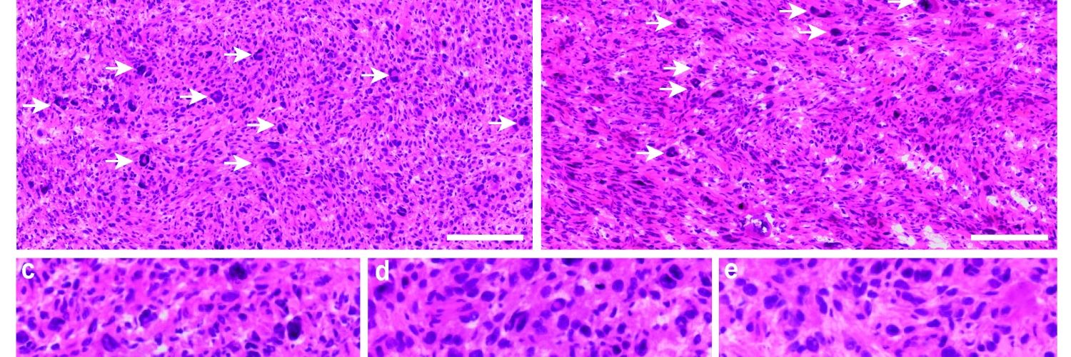 Giant cancer cells in sarcomas 