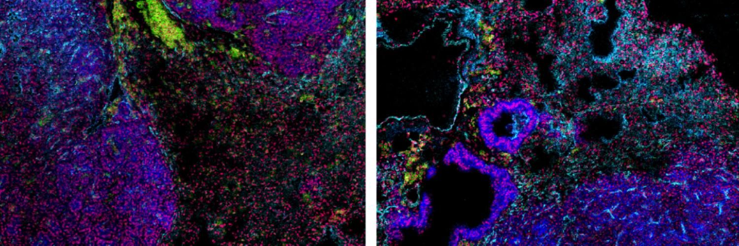 Mass cytometry images of carcinogen induced lung tumours in mice.