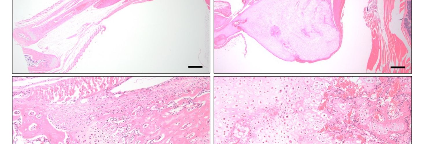 Limb malformation in PRKCA mutations